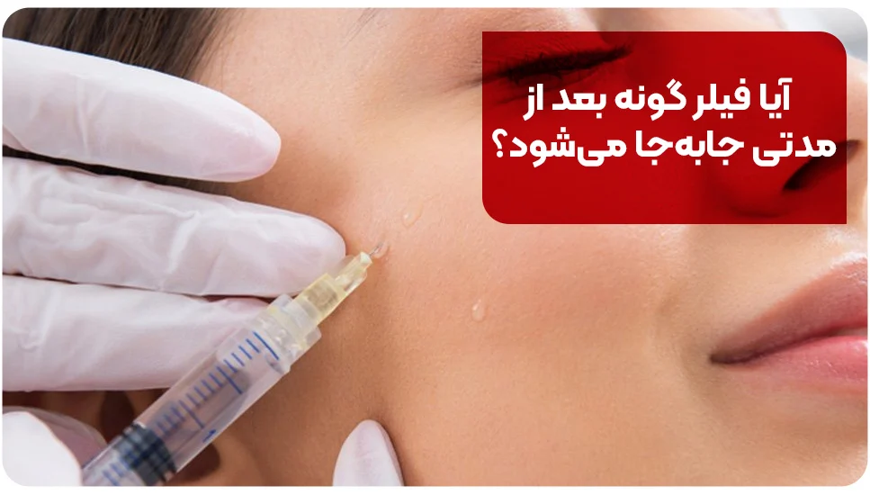 آیا فیلر گونه بعد از مدتی جابه‌جا می‌شود؟