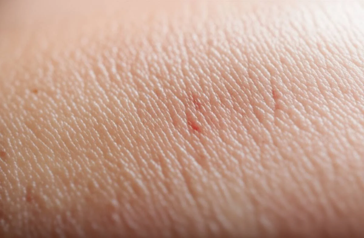 مراحل اولیه زگیل تناسلی: اولین نشانه ها چه هستند؟